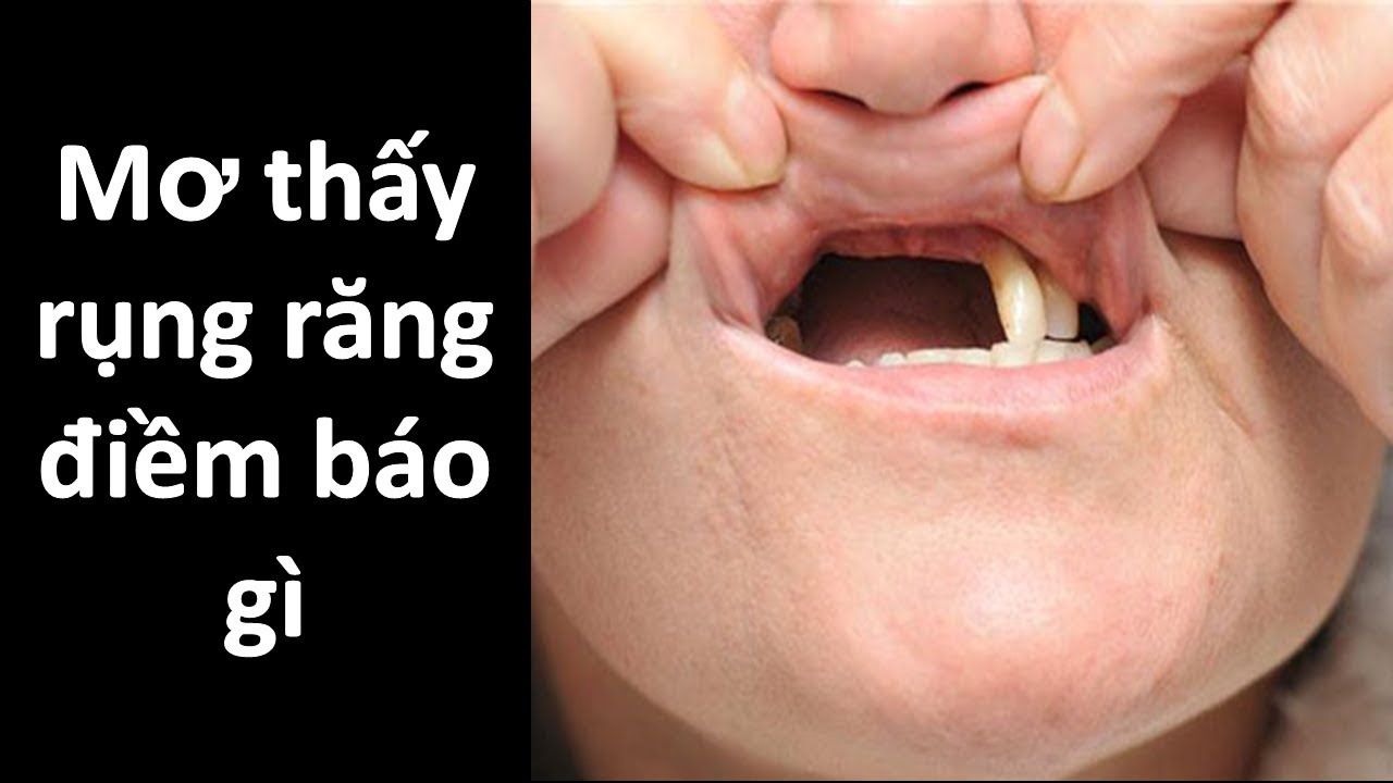 H3BET Gợi Ý Số Đề Khi Nằm Mơ Rụng Răng